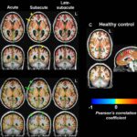 Light therapy increases brain connectivity following injury, study finds