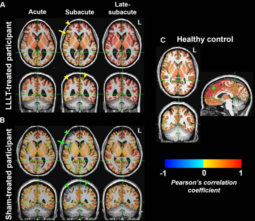 Light therapy increases brain connectivity following injury, study finds